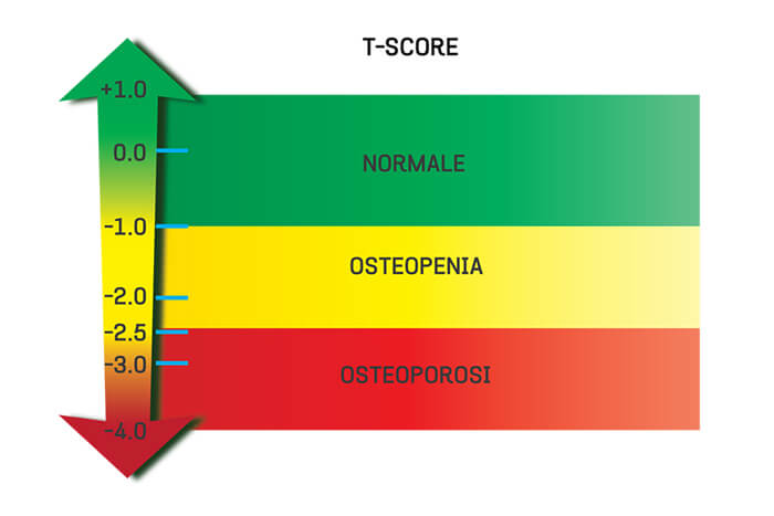 Bone Mineral Density T-Score Table
